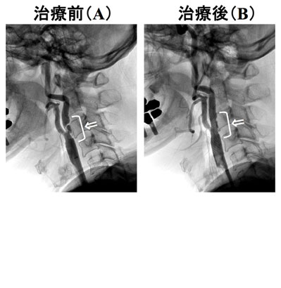 頸動脈狭窄症の診療とステント留置術の実際 頸動脈狭窄症について | 国家公務員共済組合連合会 横浜栄共済病院