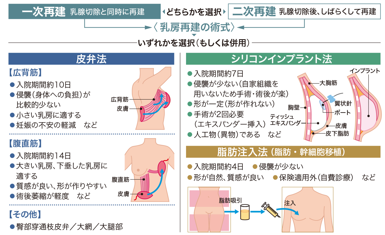 乳がん術後一期的乳房再建術 : 乳がん術式に応じた乳房再建のテクニック 美しく仕上げる 乳癌手術・乳房再建術のコツ | 森 弘樹, 座波
