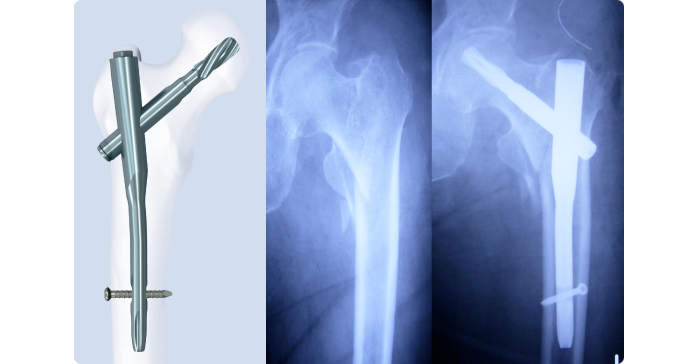 関節外科センター／外傷、関節外科、骨軟部腫瘍における関節再建専門