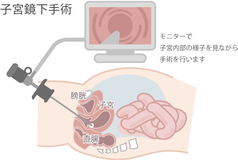 婦人科腹腔鏡手術 合併症対策とその予防 エキスパートからのメッセージ 婦人科腹腔鏡手術 合併症対策とその予防